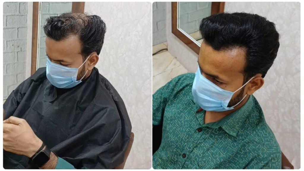 Hair Patch for Men in Delhi – Restore Your Look with Confidence