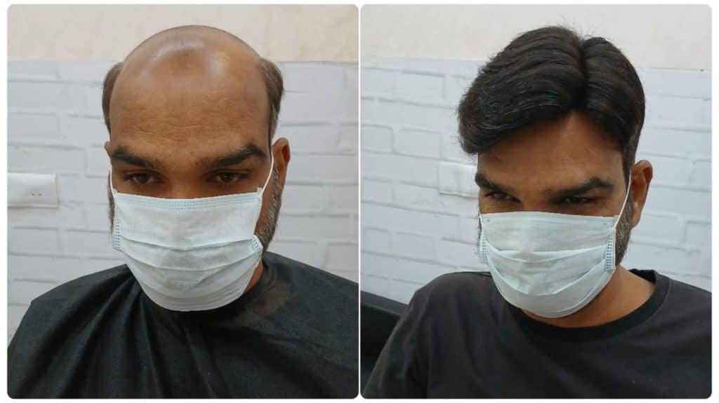 Hair Patch for Men – Your Key to a New Look