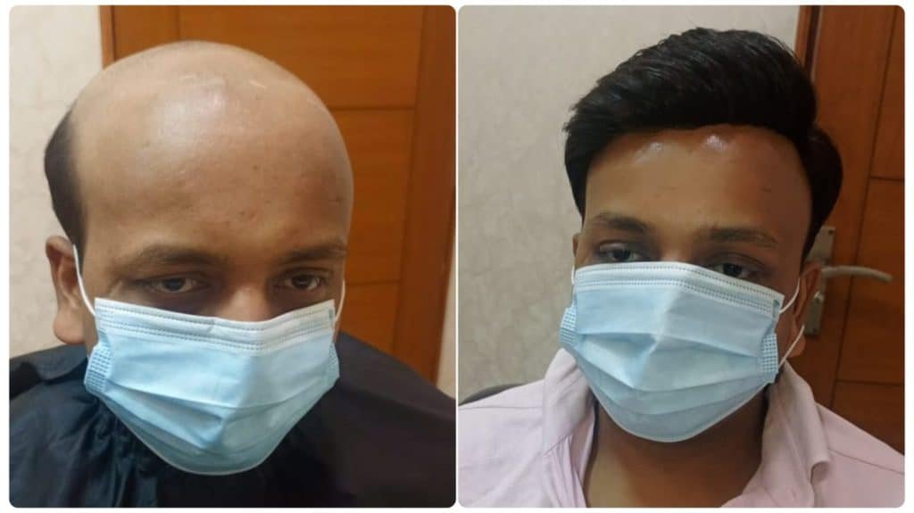 How to Avoid an Itchy Scalp While Wearing a Hair Patch